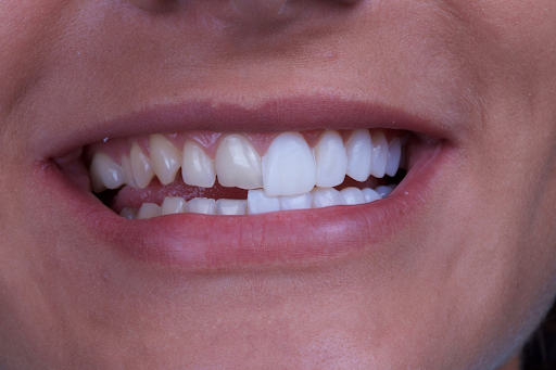 Why Choose Porcelain Veneers in Arlington for a Confident Smile? Why Choose Porcelain Veneers in Arlington for a Confident Smile?