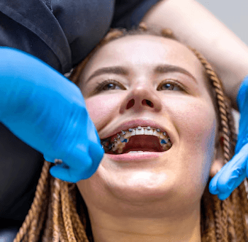 What to Check Before Choosing a Self-Ligating Braces Doctor