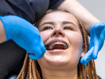 What to Check Before Choosing a Self-Ligating Braces Doctor