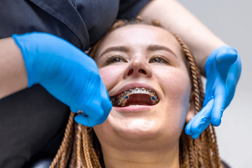 What to Check Before Choosing a Self-Ligating Braces Doctor